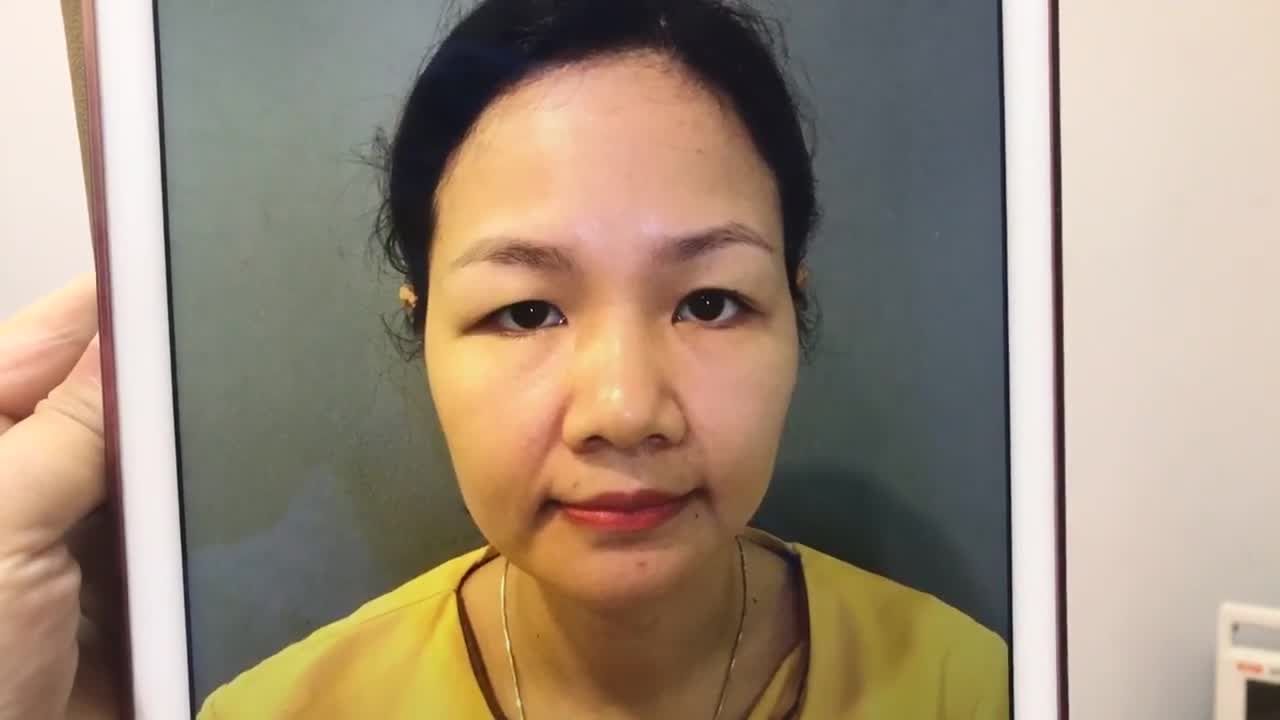 Tạm Biệt Đôi Mắt Sụp Mí Cấp Độ Nặng Chỉ Sau 40 Phút Cắt Mí - Ca 268