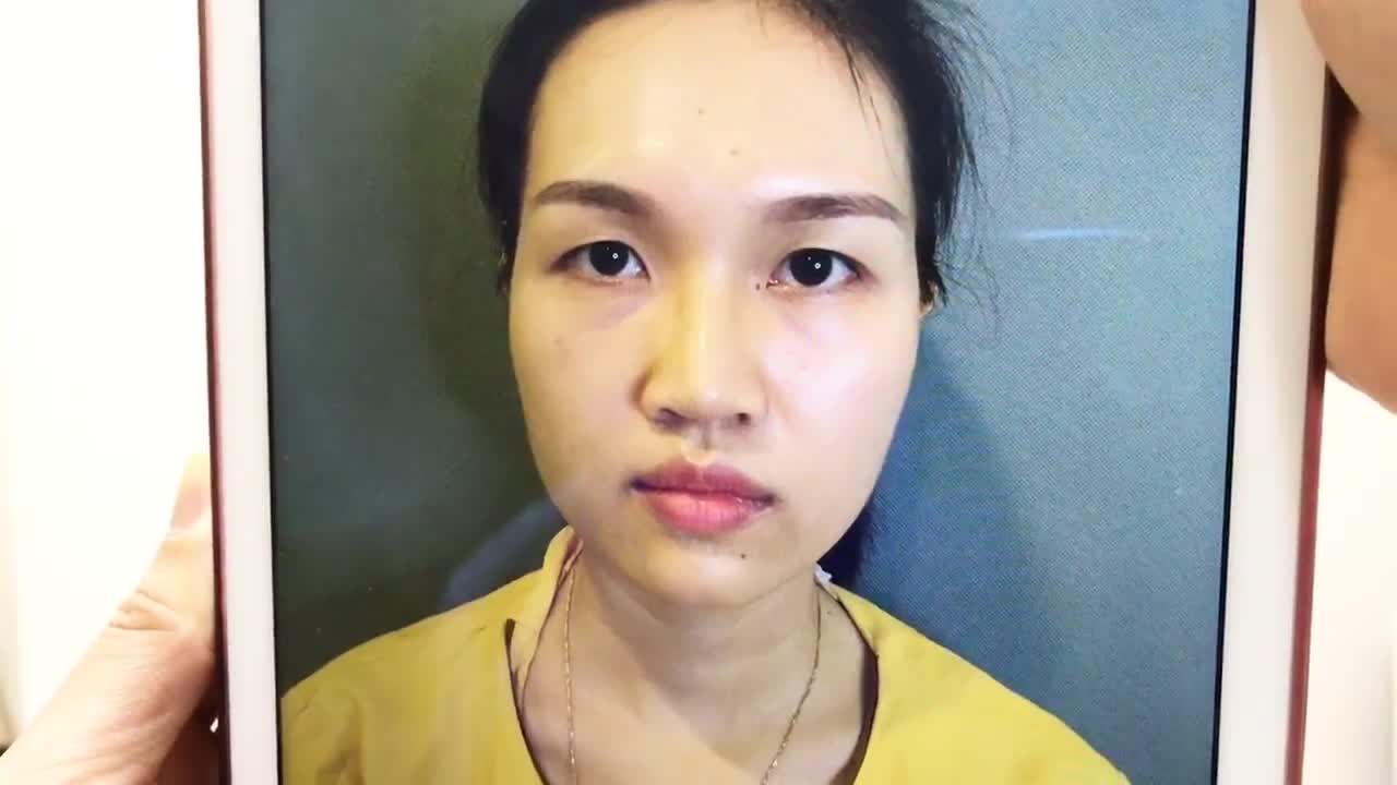 Tạo Mắt 2 Mí To Sâu Chỉ Sau 30 Phút Cắt Mí Mắt Tại Dr Hải Lê - Ca 225