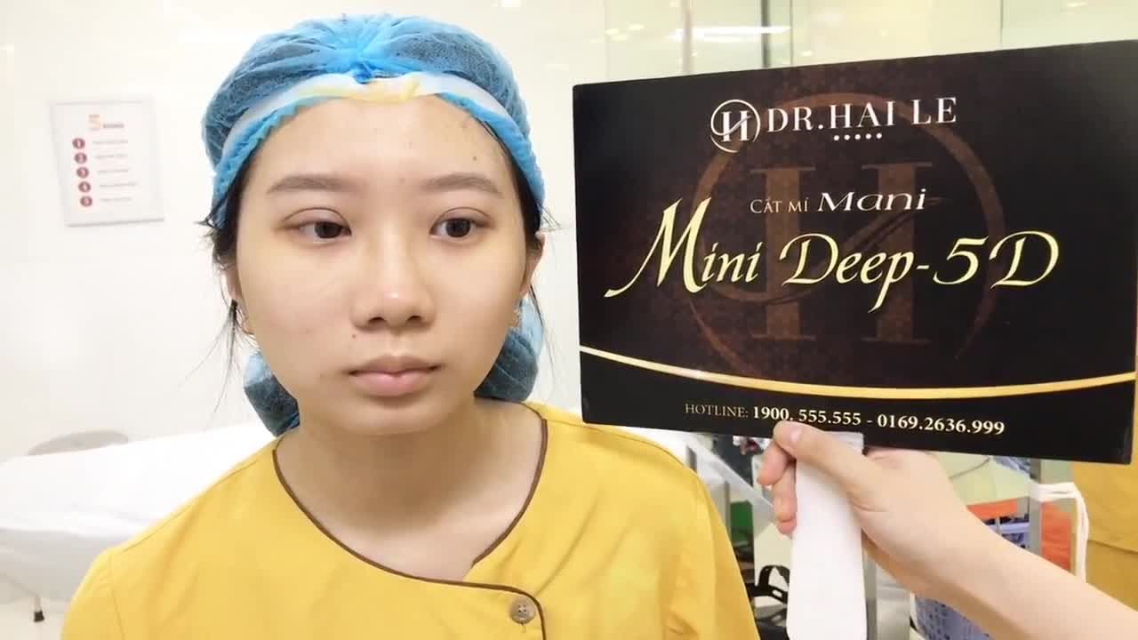 Thẩm Mỹ Chỉnh Sửa Mắt To Mắt Nhỏ Bằng Kỹ Thuật Cắt Mí Mắt Tại Dr Hải Lê - Ca 183