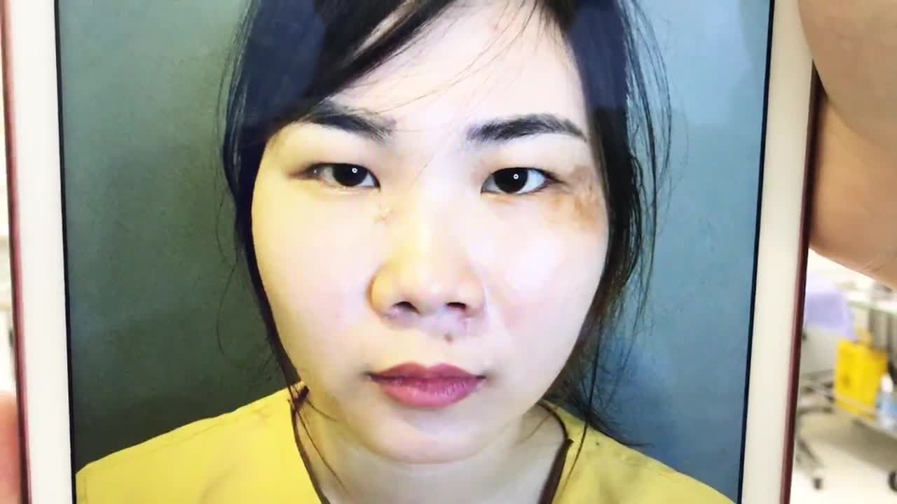 Thay Đổi 180 Độ Đôi Mắt 1 Mí Thành 2 Mí Sau Khi Cắt Mí Mắt - Ca 237