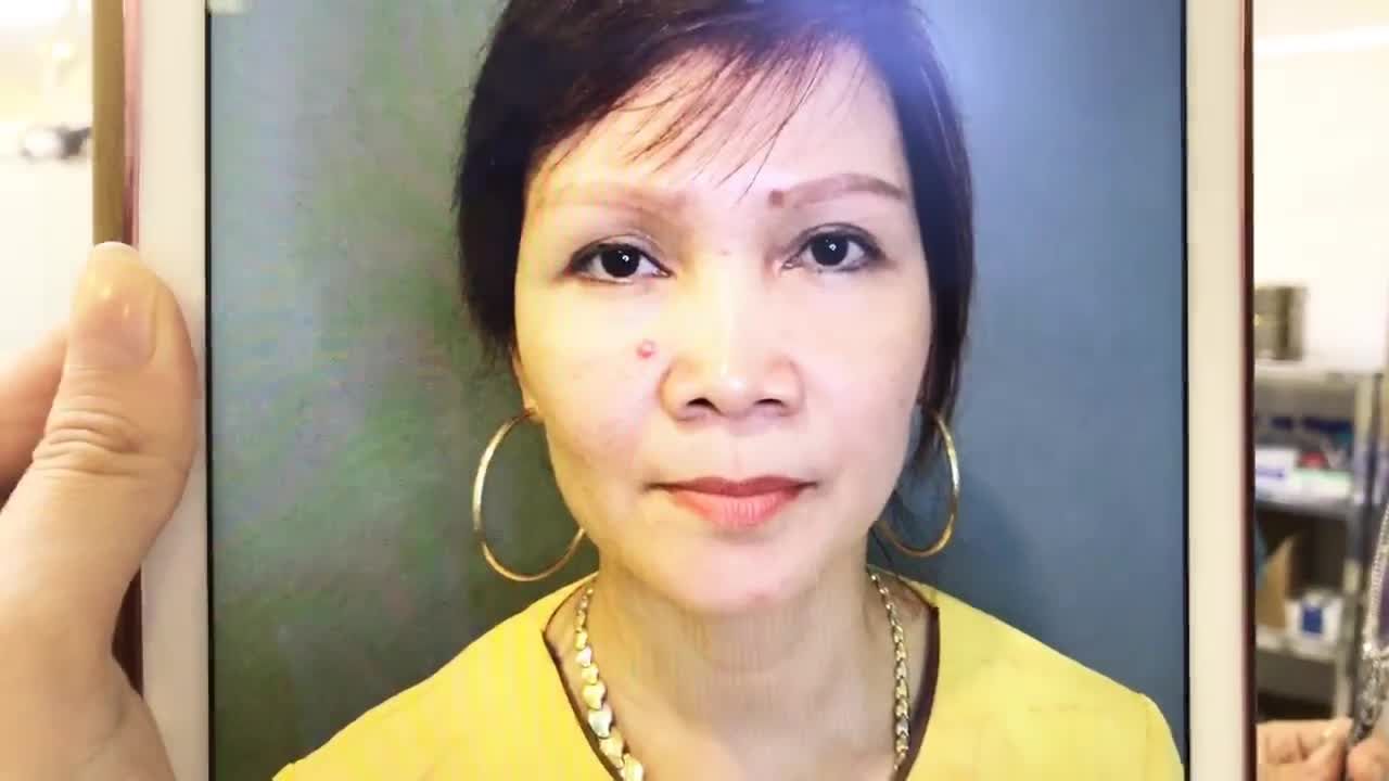 Thay Đổi Tình Trạng Mắt Mí Lót, Sụp Mí Chỉ Bằng Kỹ Thuật Cắt Mí Mani Open Deep 5D - Ca 245