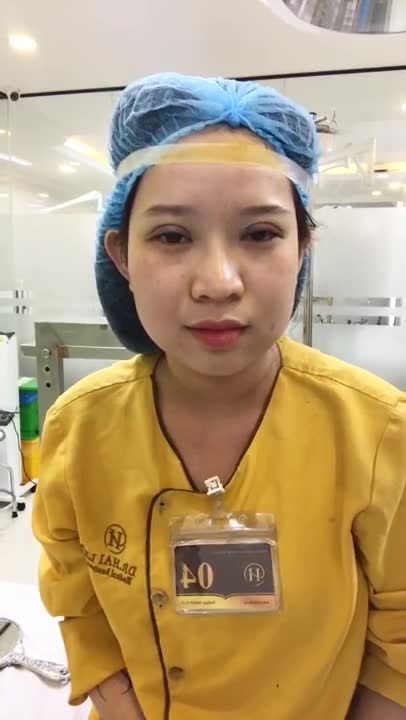 Tiếp Tục Theo Dõi 1 Ca Cắt Mí Mắt Tại Dr Hải Lê - Ca 127