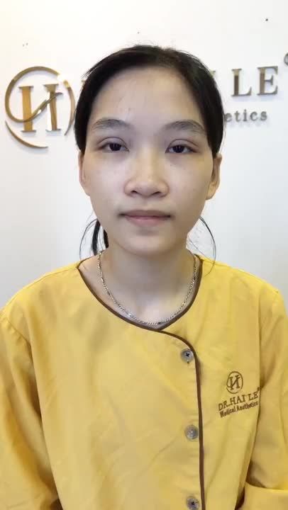 Tiếp Tục Theo Dõi Kết Quả Vừa Cắt Mí Mắt Xong Tại Dr Hải Lê - Ca 161