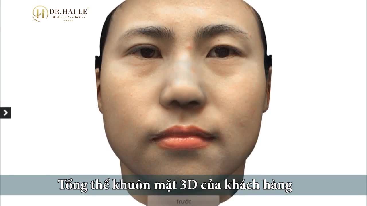 Trải Nghiệm Kết Quả Phẫu Thuật Cắt Mí Mắt 3D Chân Thực Nhất Tại Dr Hải Lê