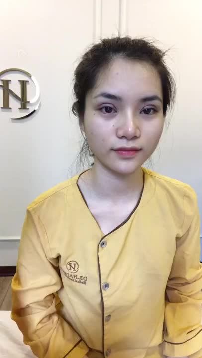 Vị KH Xinh Đẹp Chia Sẻ Kết Quả Ngay Sau Cắt Mí Mắt Tại Dr Hải Lê
