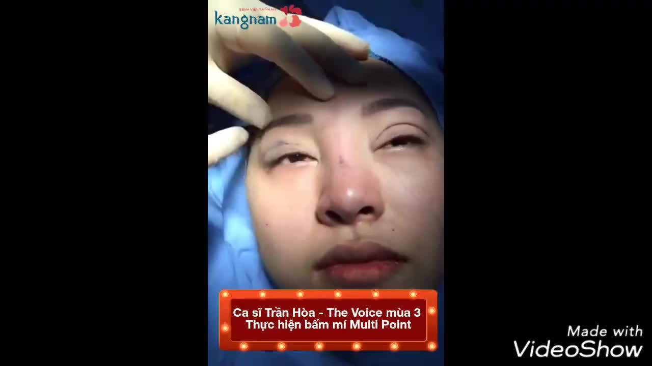 Bấm mí Multi-point - Ca 08