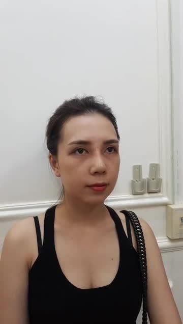 Nâng mũi cấu trúc 4D - Thẩm mỹ Kangnam - Ca 34