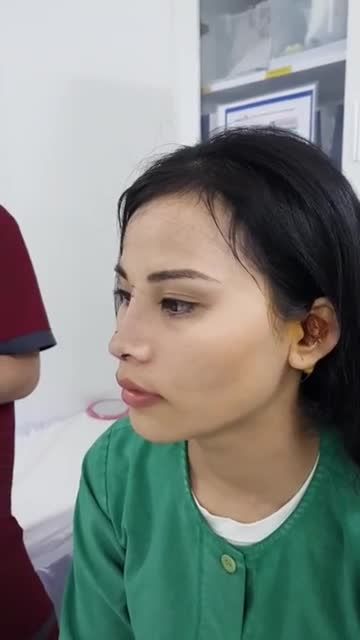 Nâng mũi cấu trúc 4D - Thẩm mỹ Kangnam - Ca 54