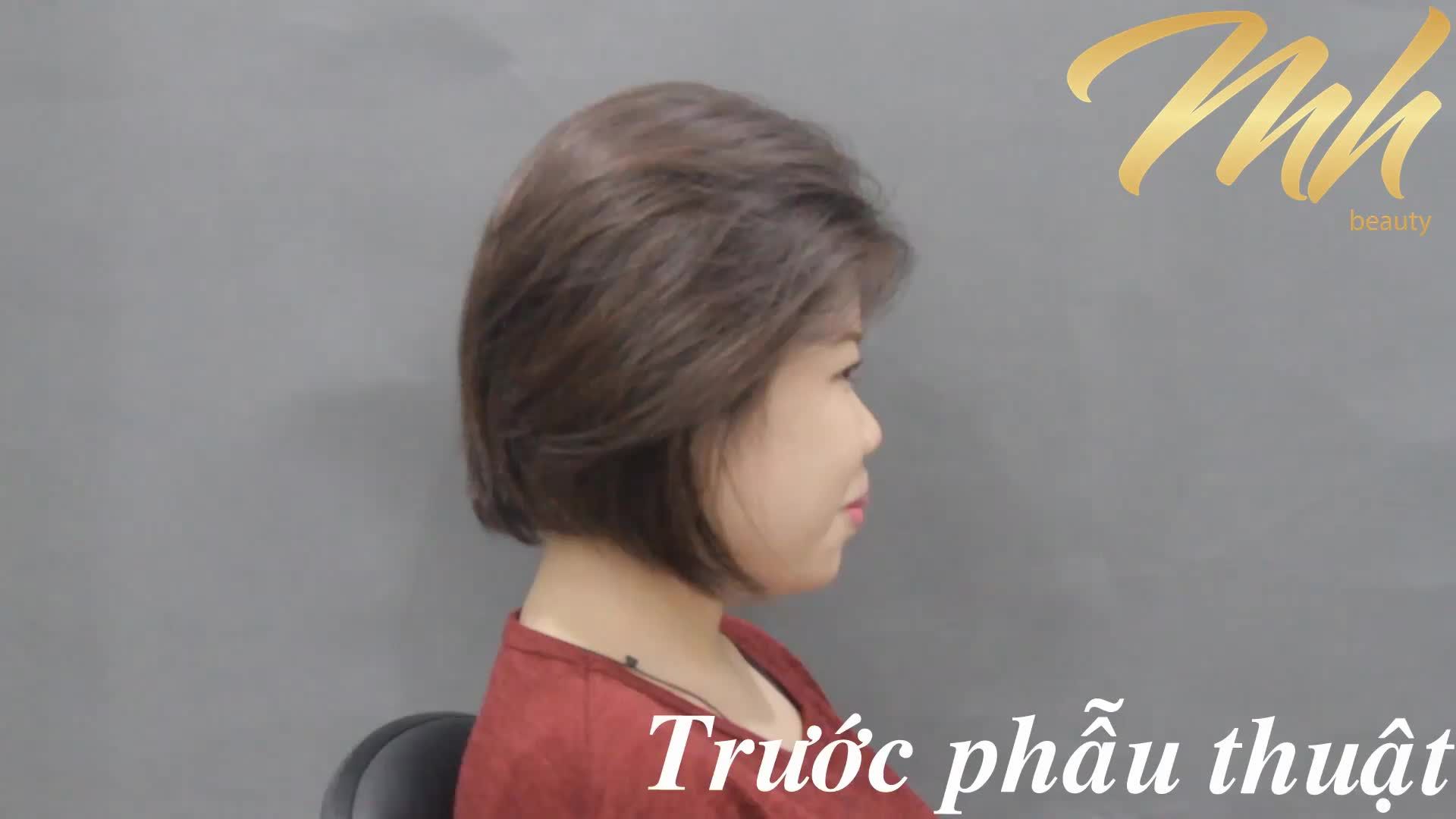 Nâng mũi - Bác sĩ Mã Hiệp - Ca 24