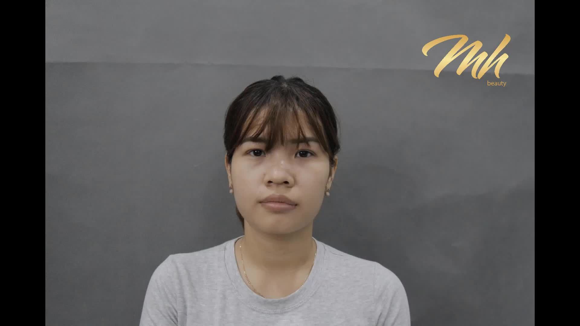 Nâng mũi - Bác sĩ Mã Hiệp - Ca 19