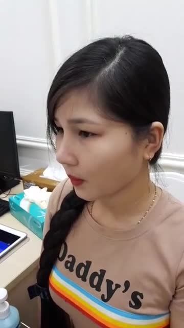 Nâng mũi bán cấu trúc 4D - Thẩm mỹ Kangnam - Ca 65