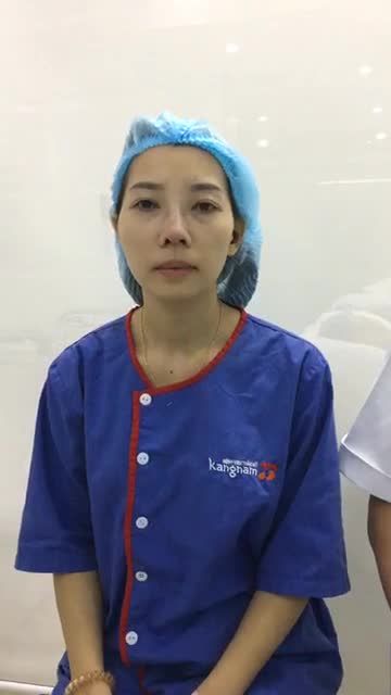 Nâng mũi cấu trúc 4D siêu âm - Thẩm mỹ Kangnam - Ca 63