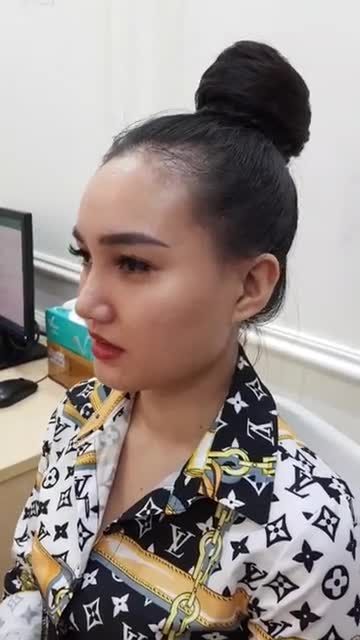 Nâng mũi cấu trúc S-line 4D - Thẩm mỹ Kangnam - Ca 61