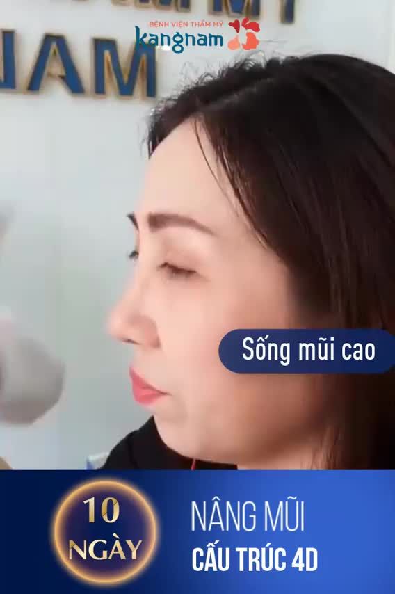 Nâng mũi cấu trúc 4D - Thẩm mỹ Kangnam - Ca 31