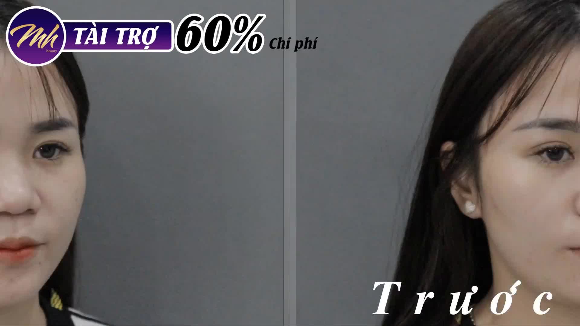 Nâng mũi - Bác sĩ Mã Hiệp - Ca 21