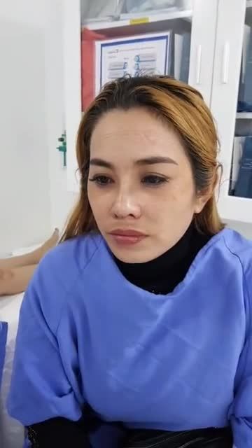 Nâng mũi cấu trúc 4D - Thẩm mỹ Kangnam - Ca 52