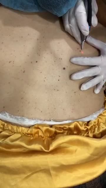 Trị mụn thịt do virut - Thẩm mỹ Kangnam - Ca 09