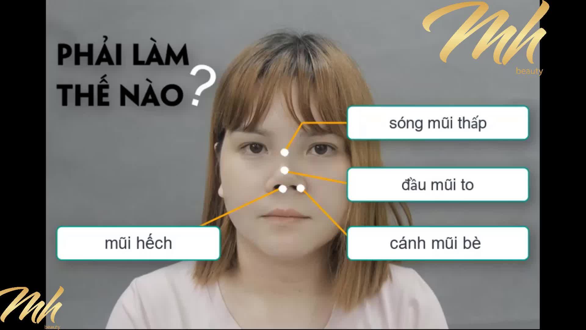 Nâng mũi - Thẩm mỹ viện MH Beauty - Ca 14