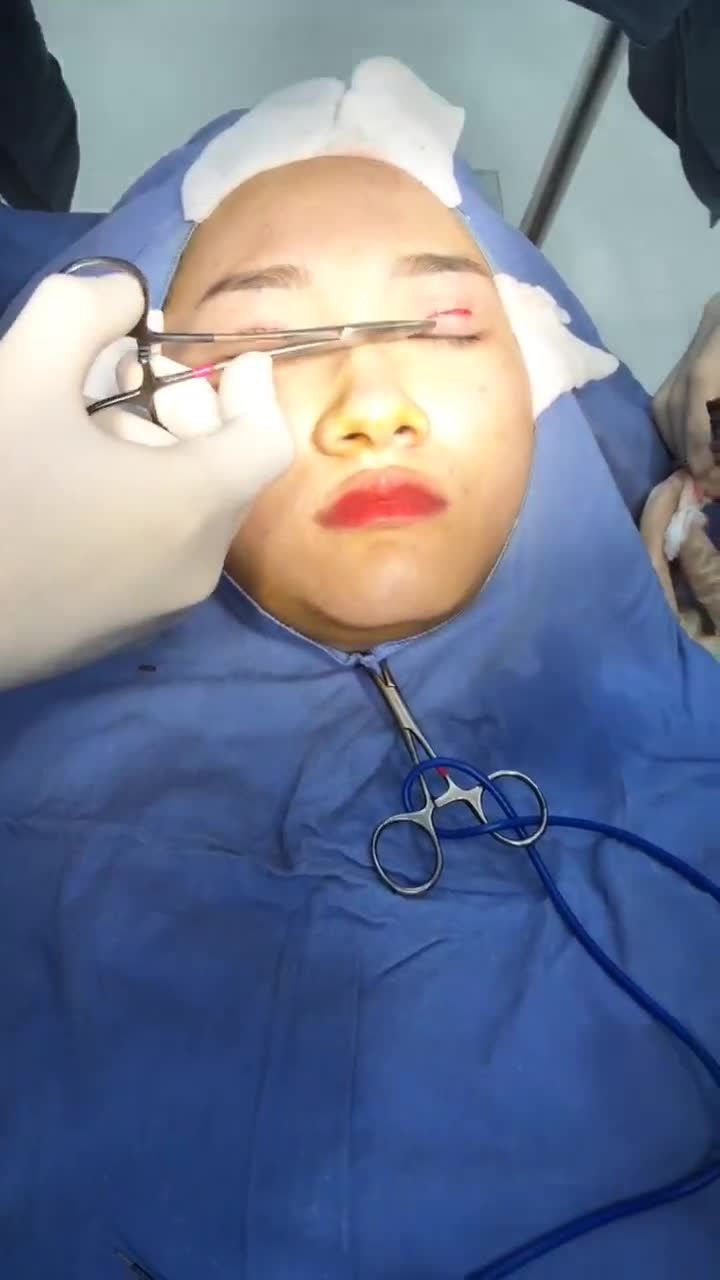 Cắt mí Plasma - Ca 04