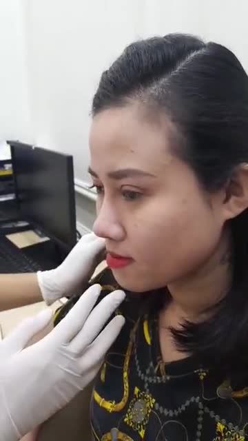 Nâng mũi cấu trúc 4D - Thẩm mỹ Kangnam - Ca 62