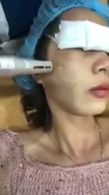 Trị tàn nhang - Thẩm mỹ Kangnam - Ca 05