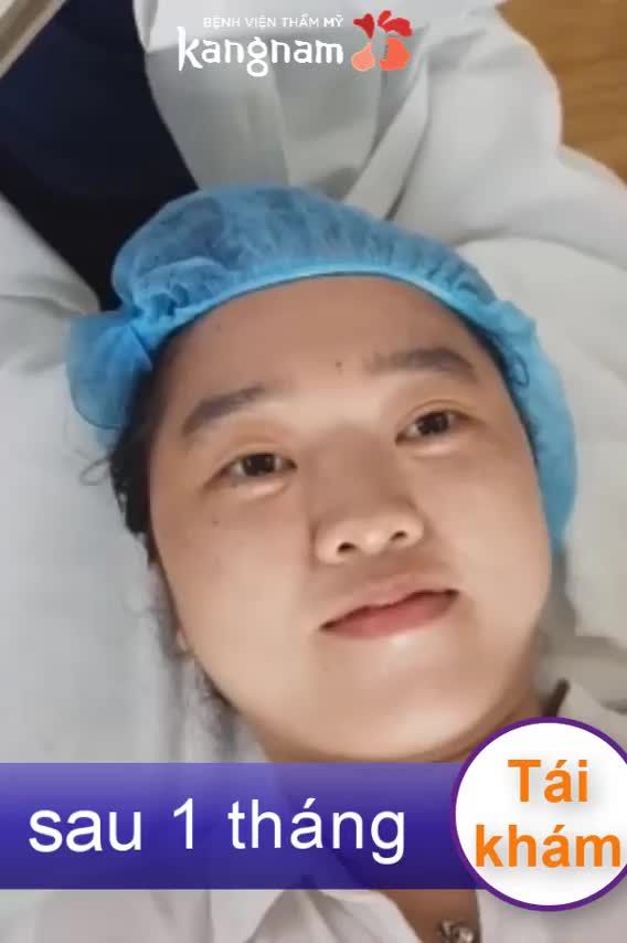 Trị tàn nhang - Thẩm mỹ Kangnam - Ca 03