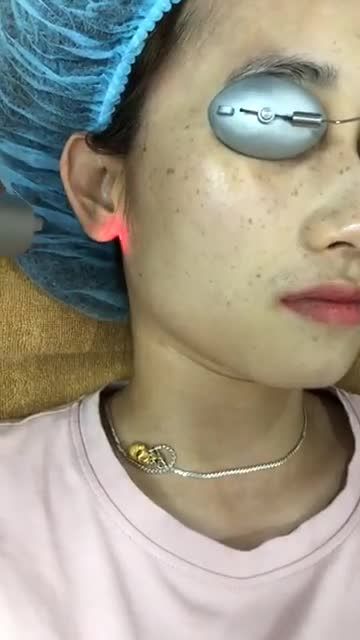 Trị tàn nhang công nghệ Picosure - Thẩm mỹ Kangnam - Ca 04