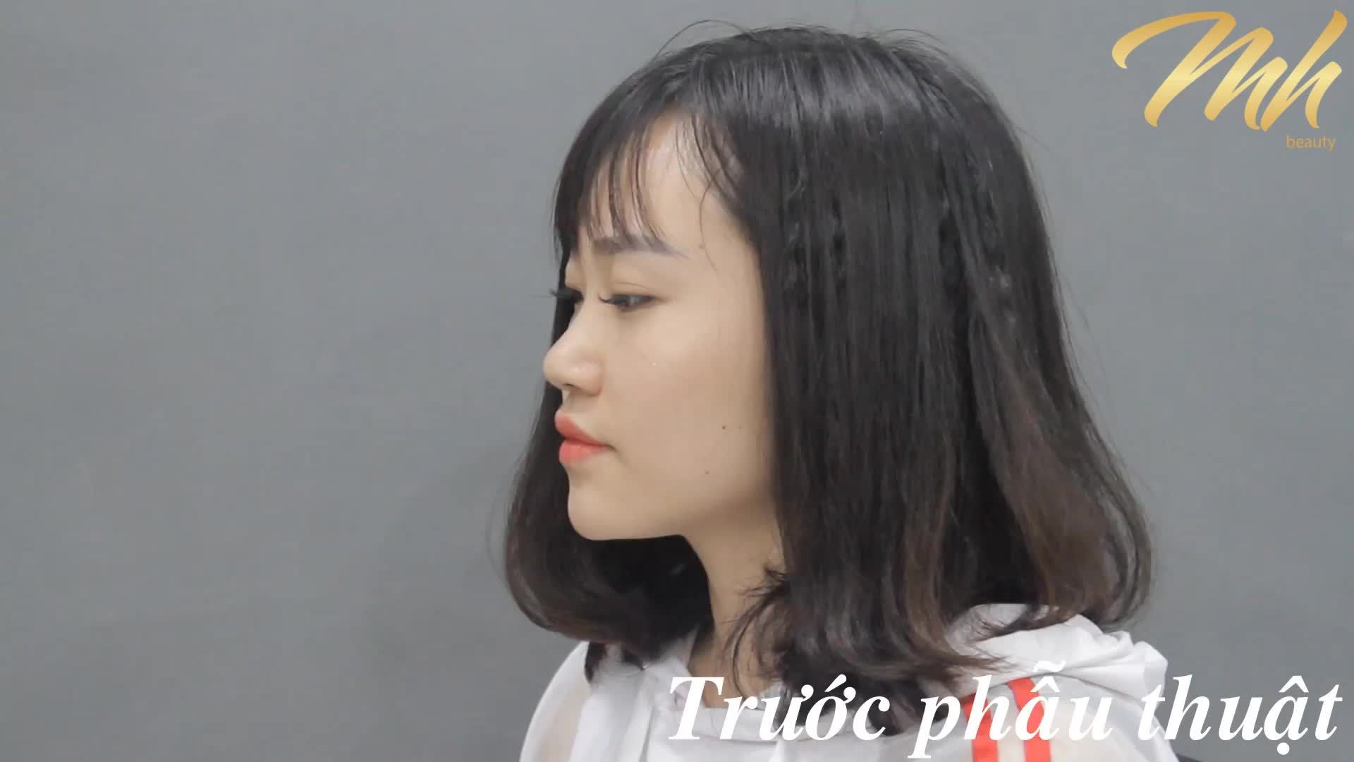 Nâng mũi - Bác sĩ Mã Hiệp - Ca 18