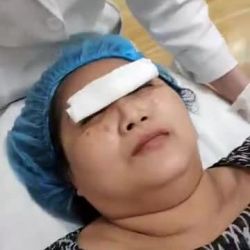 Trị tàn nhang bằng công nghệ Laser Picosure - Thẩm mỹ Kangnam - Ca 02