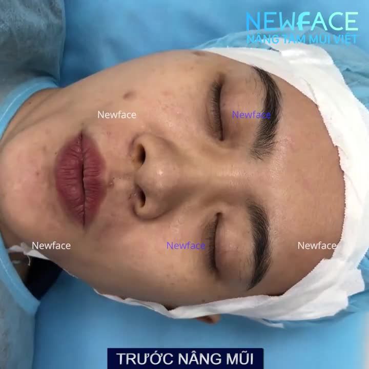 NÂNG MŨI NHẸ NHÀNG HƠN BẠN NGHĨ - NẾU KHÔNG TIN HÃY XEM NGAY VIDEO NÀY! Bs Trần Phương