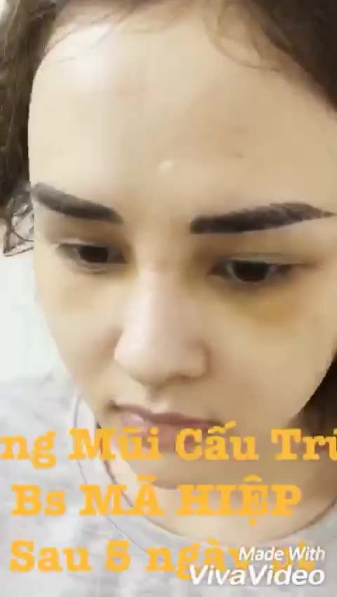 Nâng mũi - Bác sĩ Mã Hiệp - Ca 69