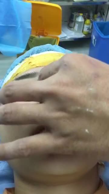 Nâng mũi cấu trúc 4D - Thẩm mỹ Kangnam - Ca 16