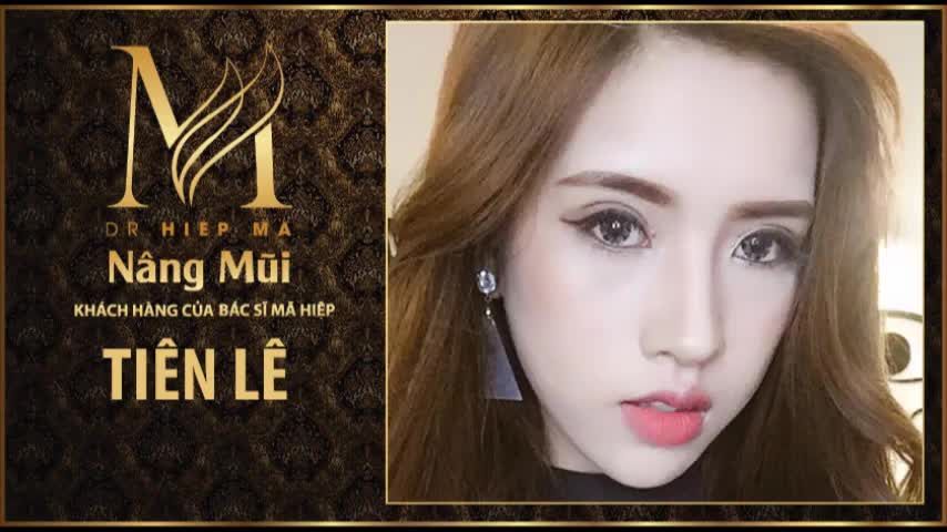 Nâng mũi - Bác sĩ Mã Hiệp - Ca 43