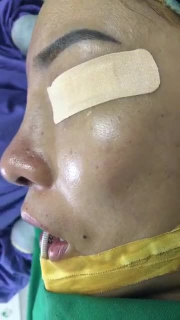 Nâng mũi cấu trúc 4D - Thẩm mỹ Kangnam - Ca 17