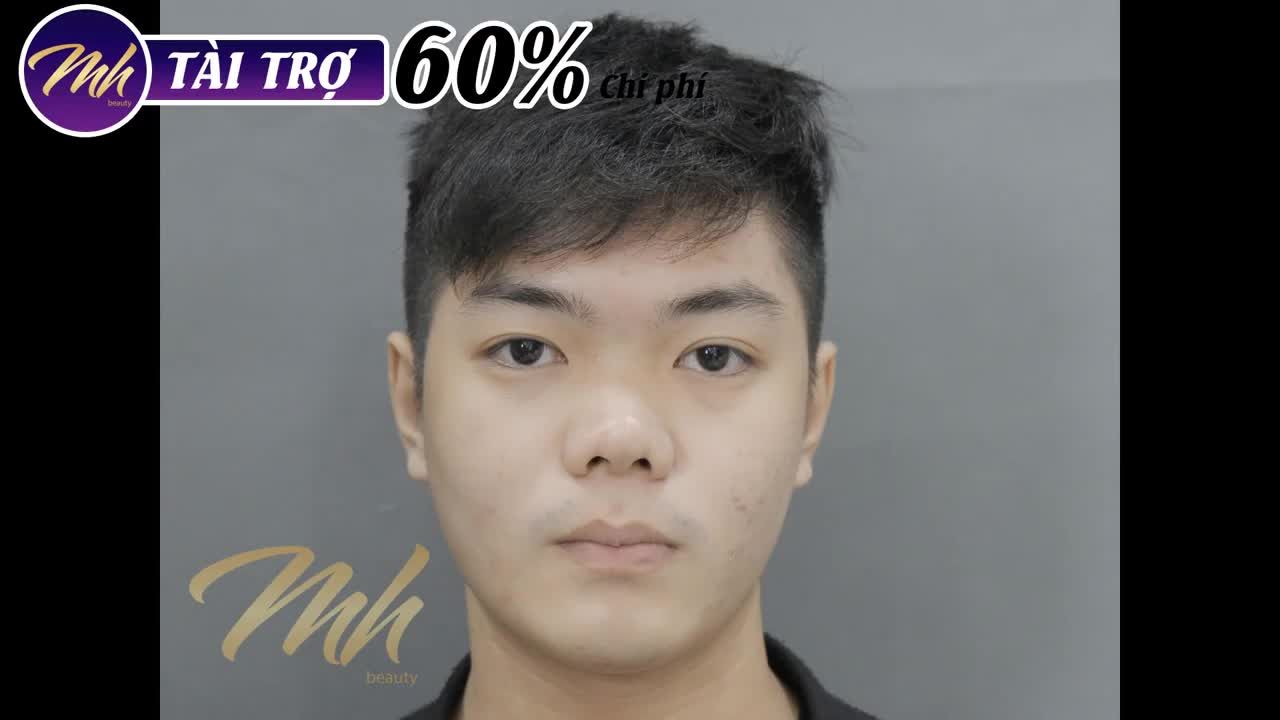 Nâng mũi - Bác sĩ Mã Hiệp - Ca 30