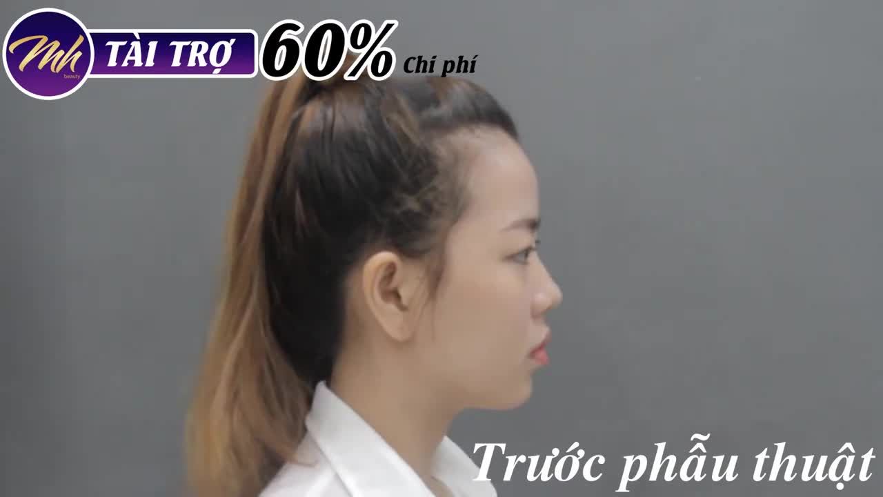 Nâng mũi - Bác sĩ Mã Hiệp - Ca 27