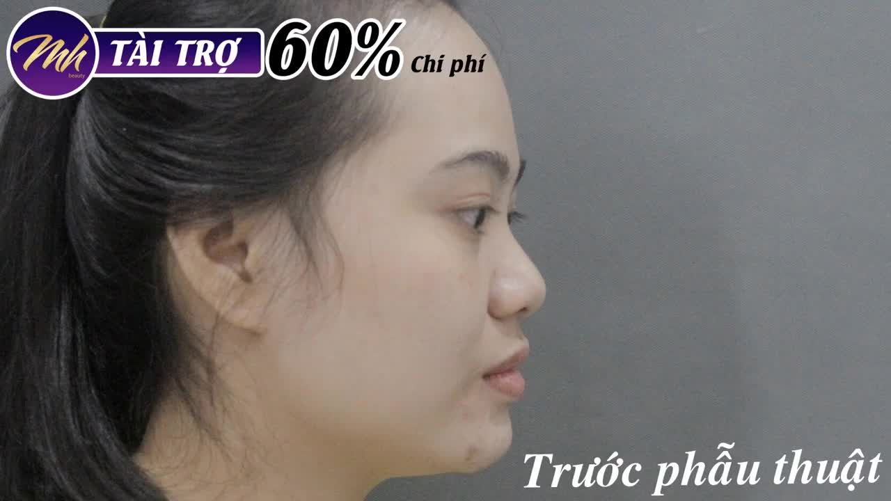 Nâng mũi - Bác sĩ Mã Hiệp - Ca 25