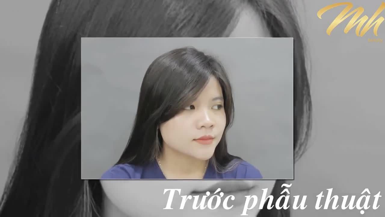 Nâng mũi - Bác sĩ Mã Hiệp - Ca 20