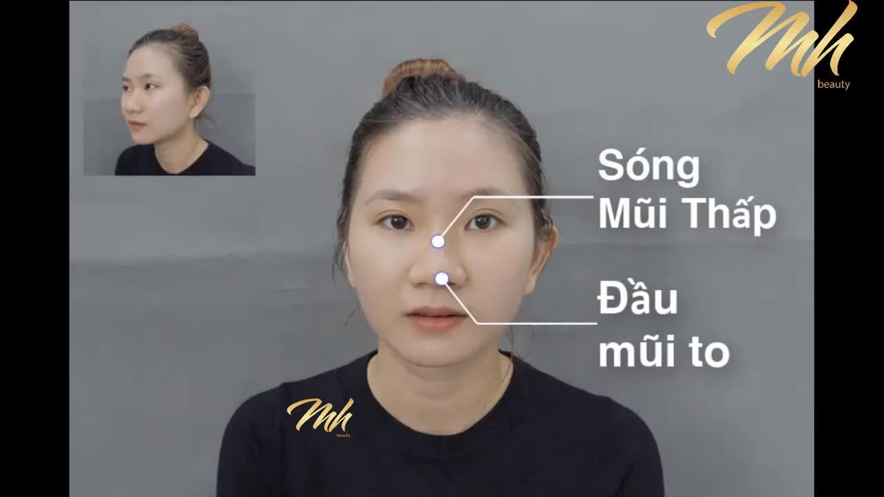 Nâng mũi - Thẩm mỹ viện MH Beauty – Ca 15