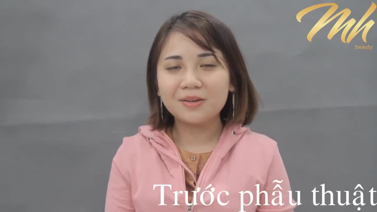 Nâng mũi - Thẩm mỹ viện MH Beauty - Ca 16