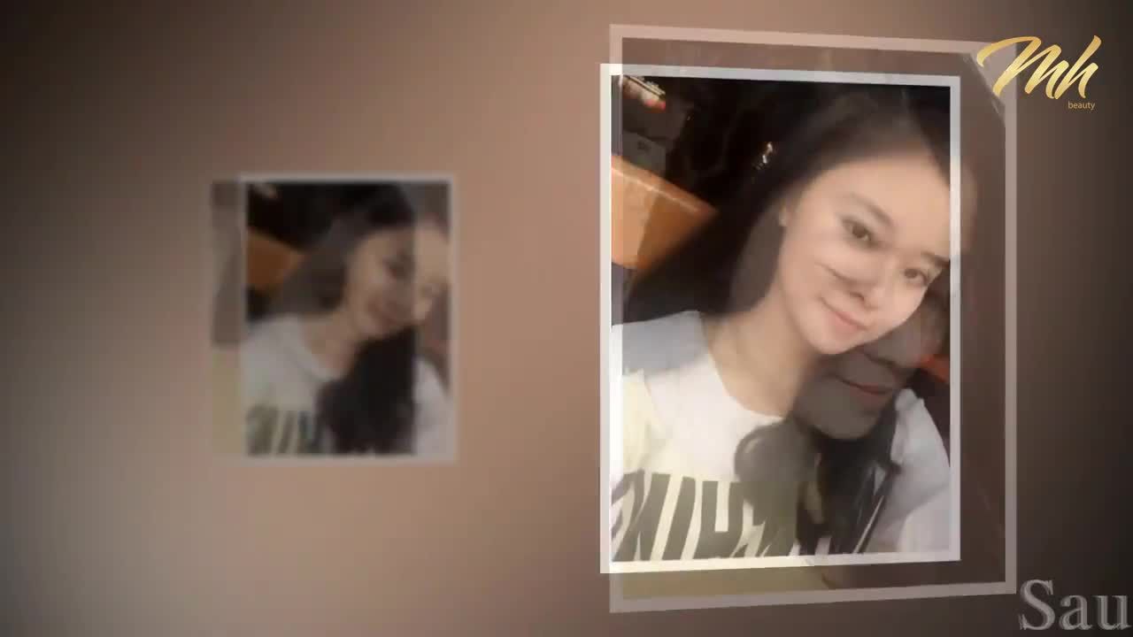 Nâng mũi - Thẩm mỹ viện MH Beauty - Ca 12