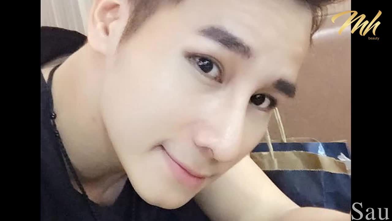 Nâng mũi cấu trúc - Thẩm mỹ viện MH Beauty - Ca 11