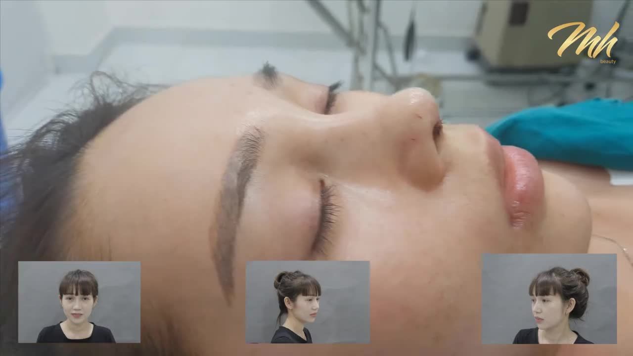 Nâng mũi - Thẩm mỹ viện MH Beauty - Ca 10