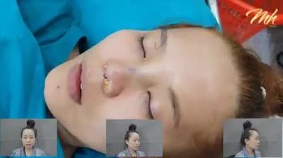 Nâng mũi - Thẩm mỹ viện MH Beauty - Ca 01