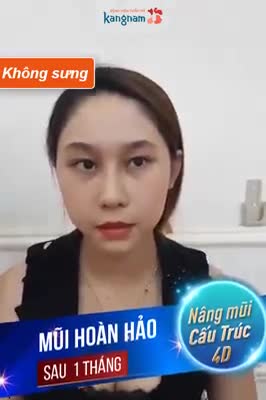 Nâng mũi cấu trúc 4D - Thẩm mỹ Kangnam - Ca 46