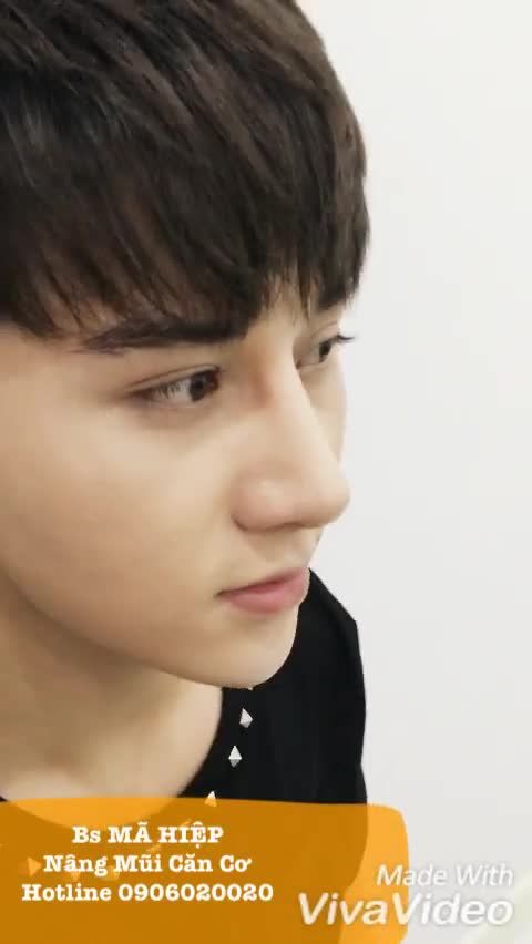 Nâng mũi - Bác sĩ Mã Hiệp - Ca 65