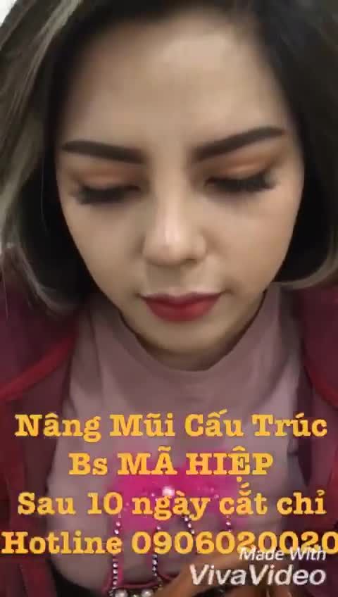 Nâng mũi - Bác sĩ Mã Hiệp - Ca 67