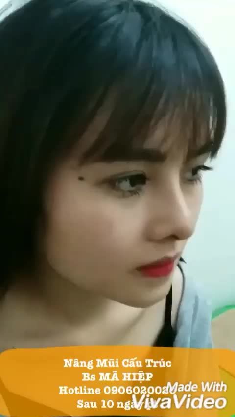 Nâng mũi - Bác sĩ Mã Hiệp - Ca 66
