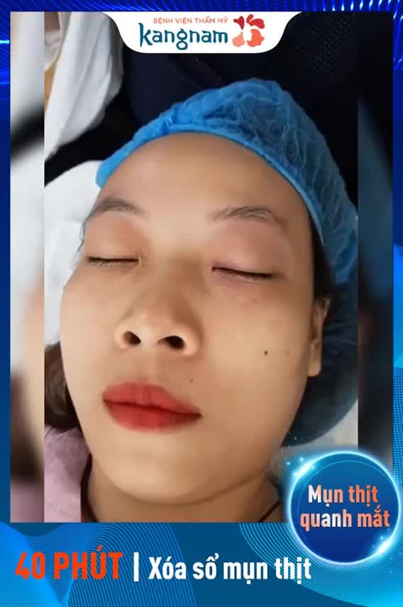 Trị mụn thịt quanh mắt - Thẩm mỹ Kangnam - Ca 02