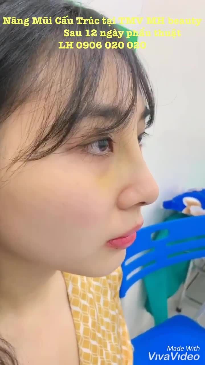 Nâng mũi cấu trúc - Thẩm mỹ viện MH Beauty - Ca 05